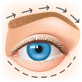 Eye surgery